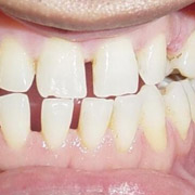Perfect Smile Veneers
