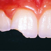 Perfect Smile Veneers