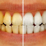 Perfect Smile Veneers
