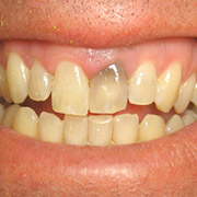 Perfect Smile Veneers