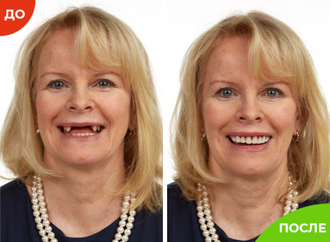 Perfect Smile Veneers