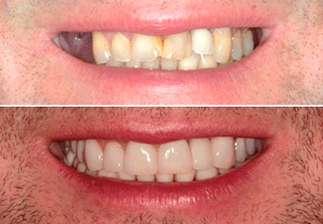 Perfect Smile Veneers