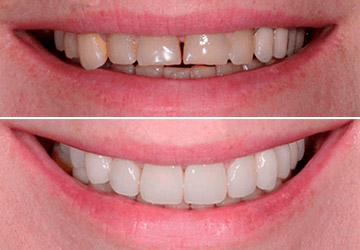 Perfect Smile Veneers