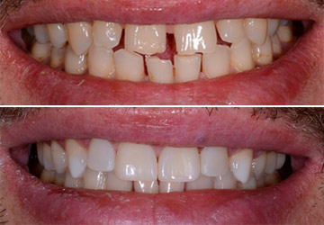 Perfect Smile Veneers